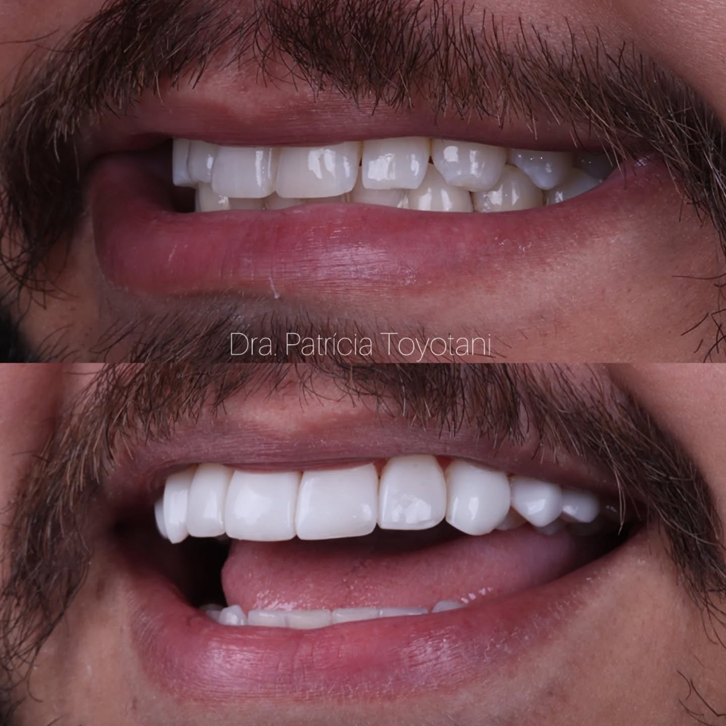 Antes e depois — transformação dental por Dra. Patricia Toyotani, Maringá