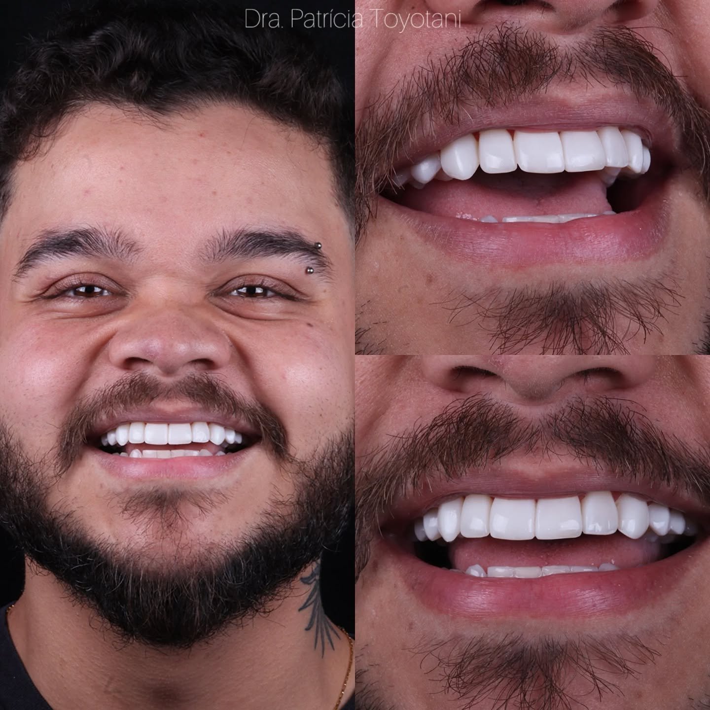Antes e depois — sorriso transformado por Dra. Patricia Toyotani, Maringá
